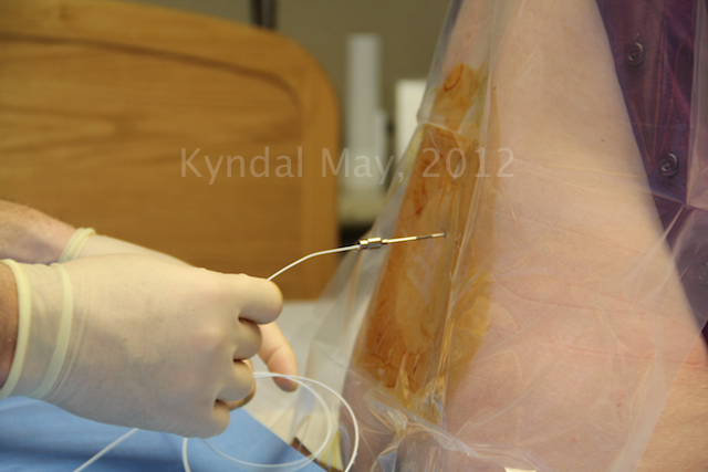 epidural, placement, procedure, catheter, Boise, doulas, doula, childbirth